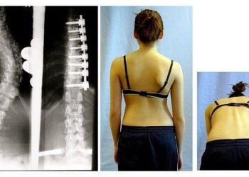 預防骨質疏鬆，你真的吃對了嗎？