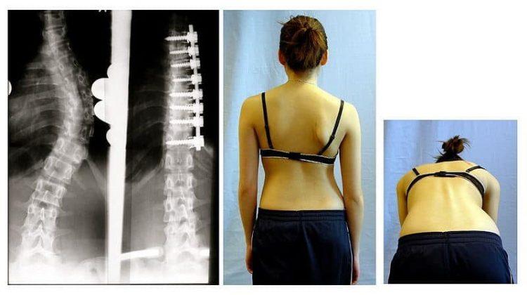 預防骨質疏鬆，你真的吃對了嗎？