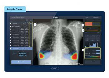 Vuno 人工智慧快速判讀胸部X光軟體