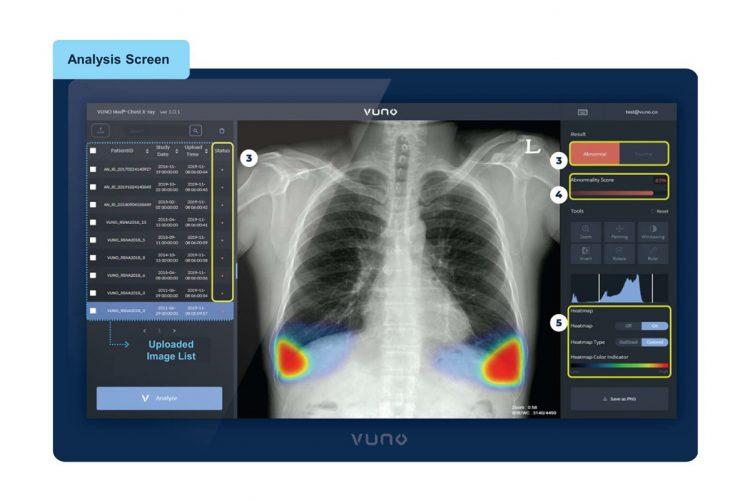 Vuno 人工智慧快速判讀胸部X光軟體