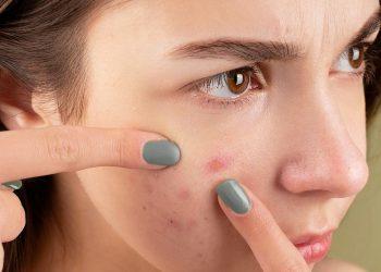 圖說：隨意擠壓青春痘恐釀發炎，甚至留下永久性痘疤。（資料來源：Pexels）