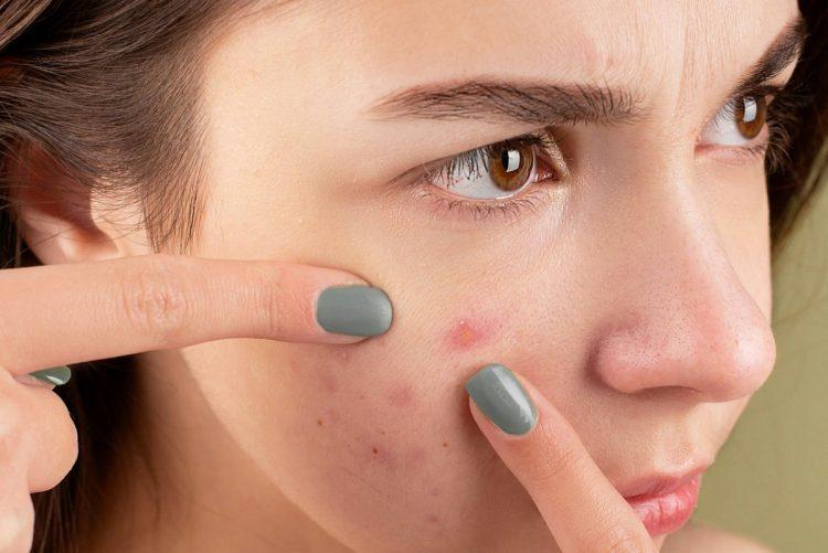 圖說:隨意擠壓青春痘恐釀發炎,甚至留下永久性痘疤。(資料來源:Pexels)